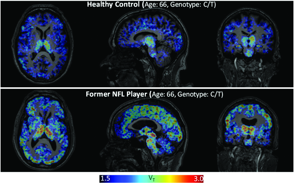 Comparison of brain of NFL player to healthy brain