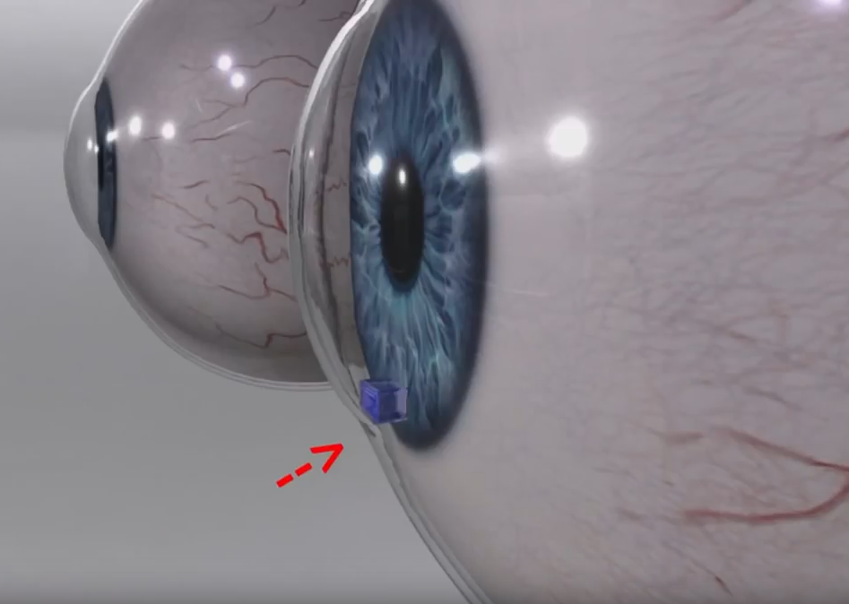 Device for early intervention against glaucoma